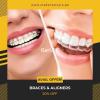 Aligners  Metallic Braces Metal Logos